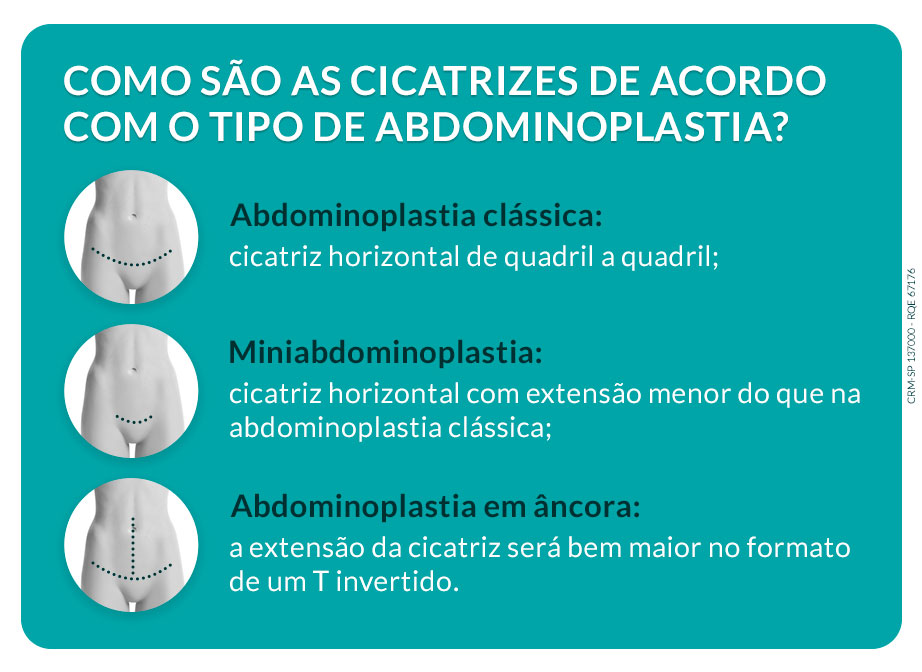 Cicatriz abdominoplastia: como fica após a cirurgia?
