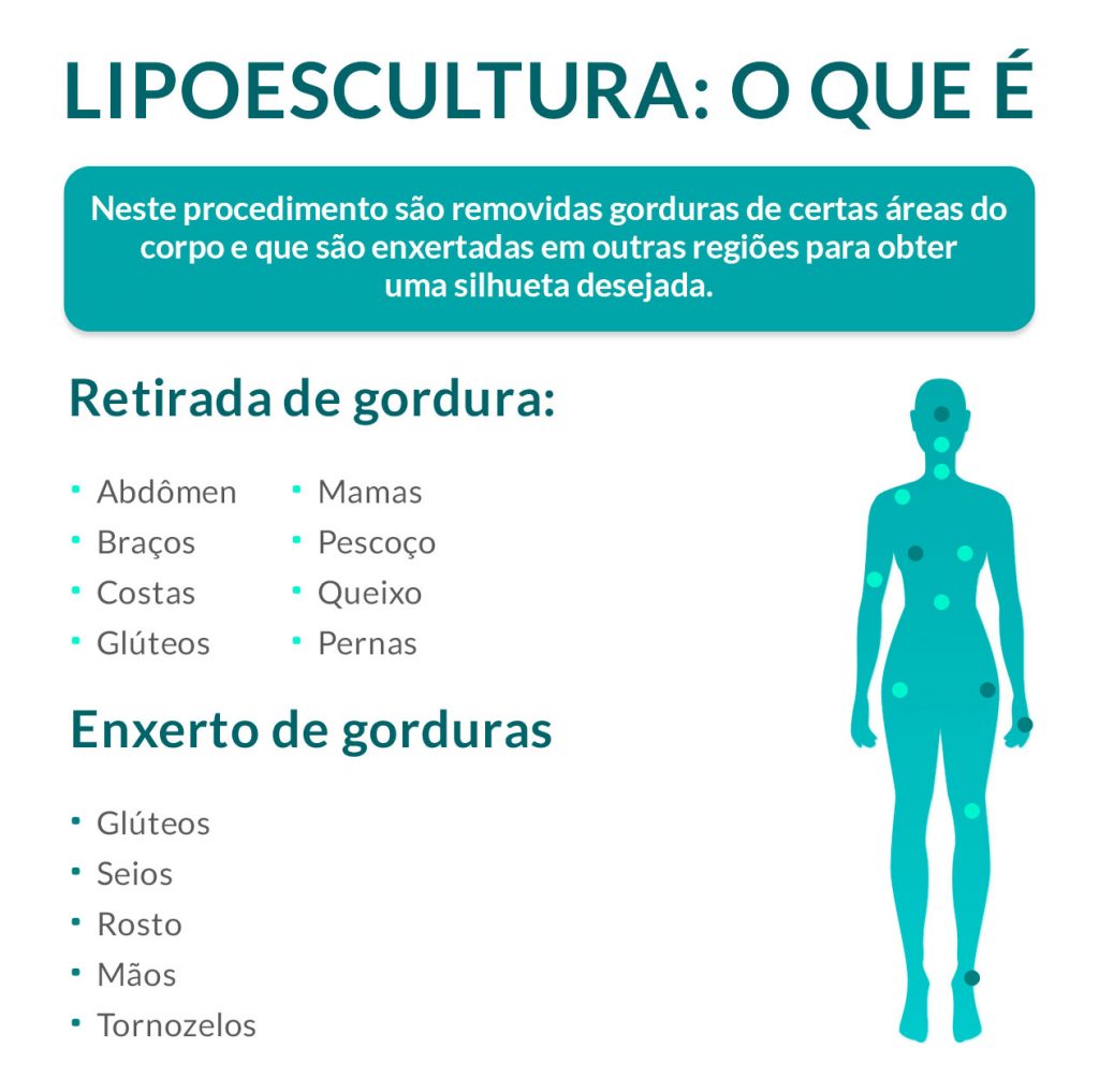 Lipoescultura: o que é Lipoescultura: tudo o que você precisar saber